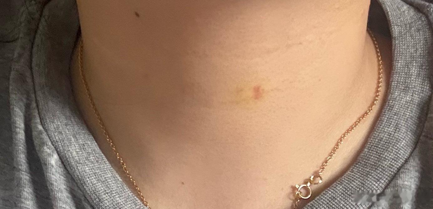 我这个颈纹打得是真有效啊…… 