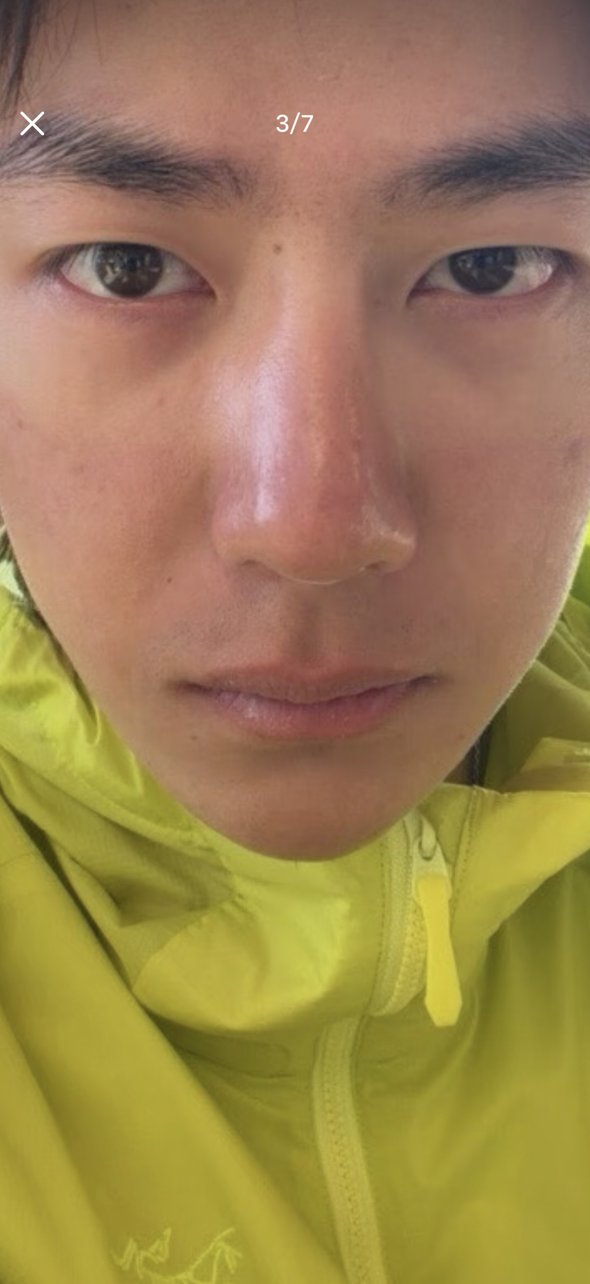 我笑吐了。。。。面罩印子。。。晒分层了。。。 ​​​