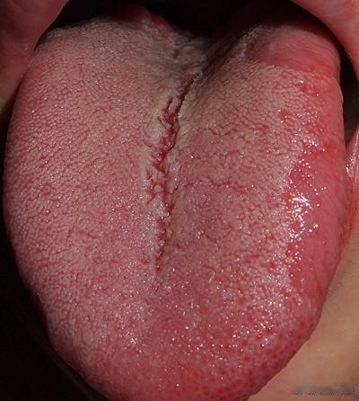 舌头中间有裂纹，预示有什么病？1、气血不足；气血不足的，所以舌头会干瘪枯萎不饱满