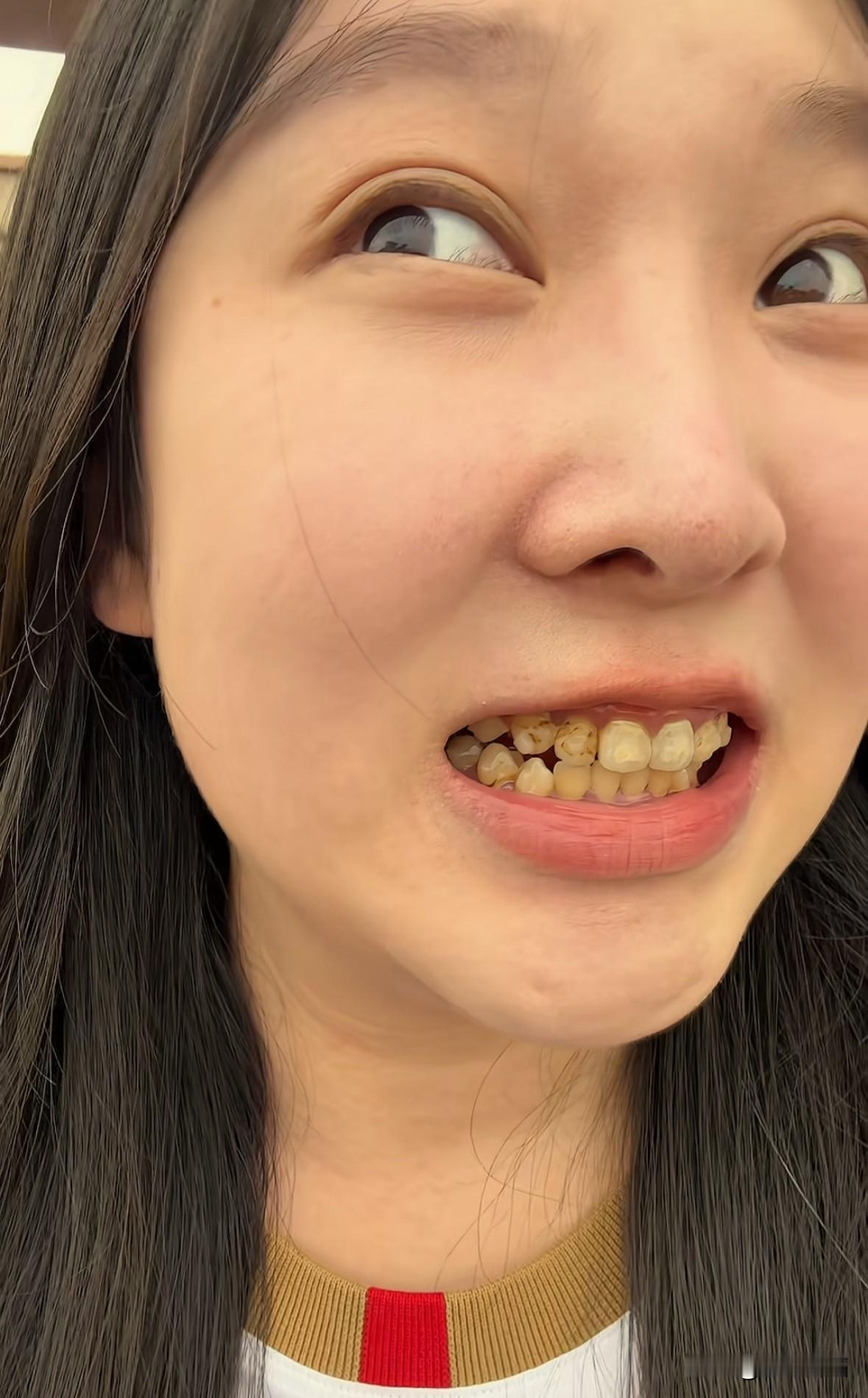 哈哈，闺蜜变美了！之前有牙黄的她，每次在外聚会或出游从来不敢正视我们笑，老说自己