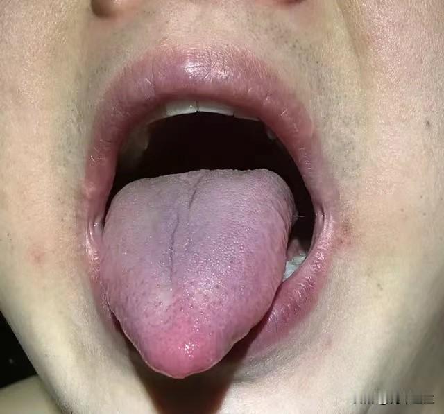 体内瘀血，气血不达宗筋，怎么能够“站”的起来？
这位粉丝来找我咨询的时候非常焦虑