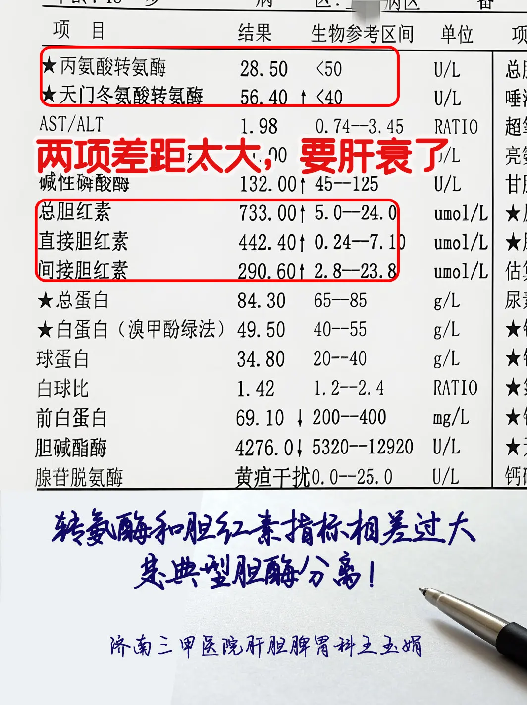 这是一位45岁山东患者的化验单，正处于肝硬化失代偿期，虽然单看转氨酶指...