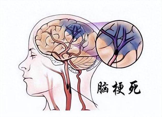 脑梗死 脑栓塞