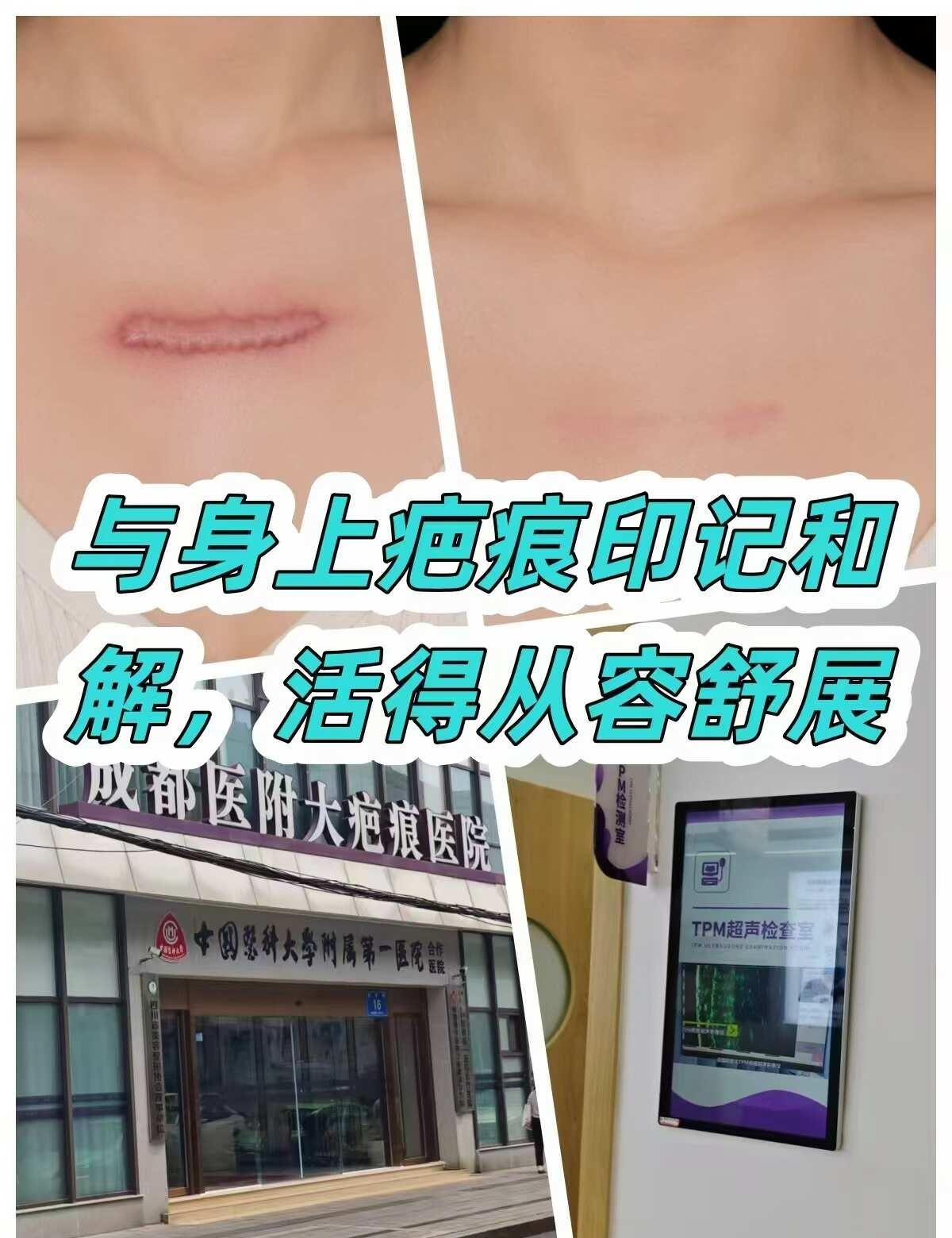 与身上疤痕印记和解，活得从容舒展
胸口凸起泛红的疤痕增生是我长久的心病，不管晴天