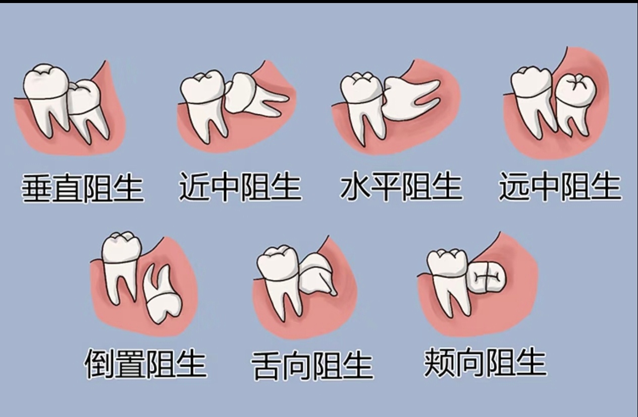 那我花钱去拔智齿算什么要是所有智齿都这么乖就好了姐的两颗都是难度最高的水平阻生至