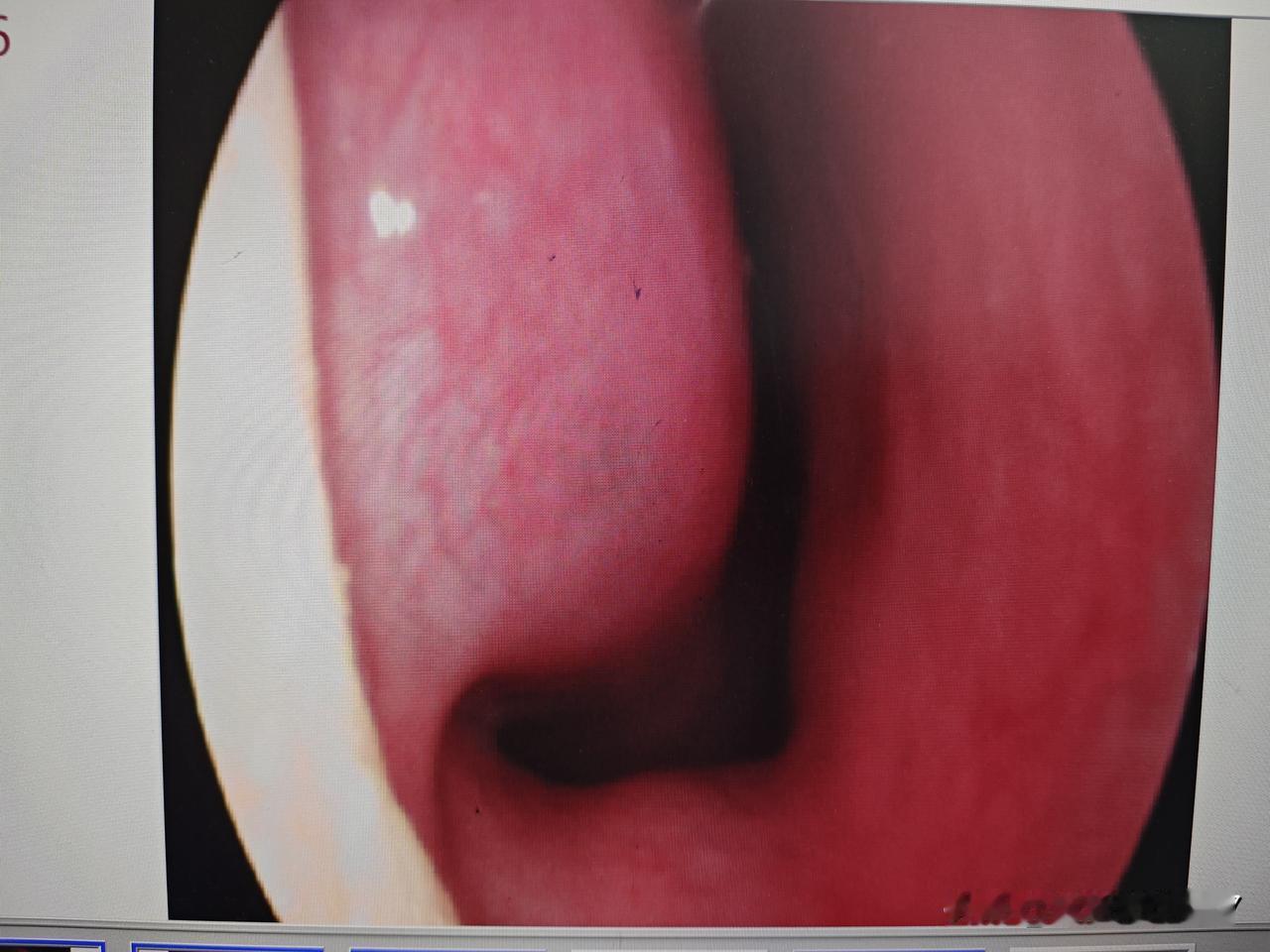 今天门诊接诊了一位5岁的小患者，家长说孩子睡觉打鼾的情况已经持续一年多了。通过鼻