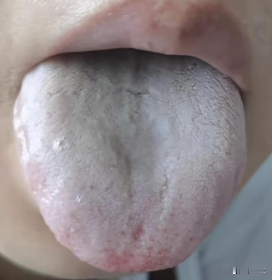 舌头胖大有齿痕，别再拖着了

今天看诊了一个患者，我一看她舌象吓了一跳，满口都是