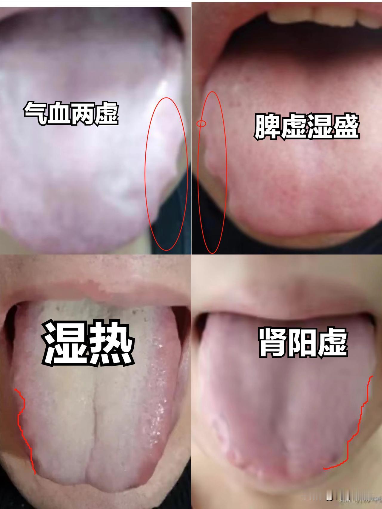 常见的齿痕舌有这几个原因，这个不知道，你简单的治湿气完全不顶用

1. 肾虚
舌