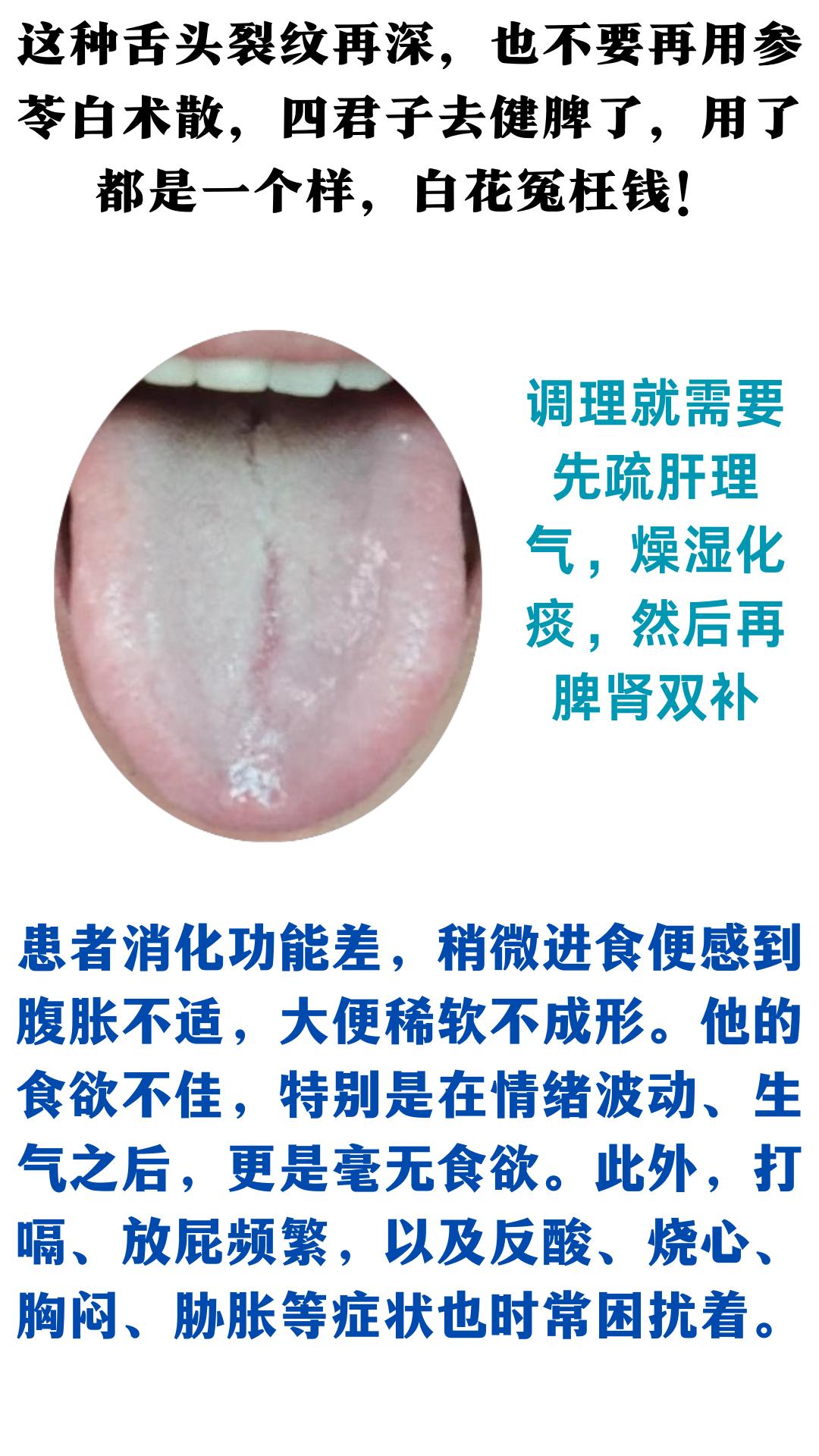 舌头案例分析，
这种舌头，舌苔白腻，裂纹，疏肝理气，燥湿化痰，然后再脾肾双补。#