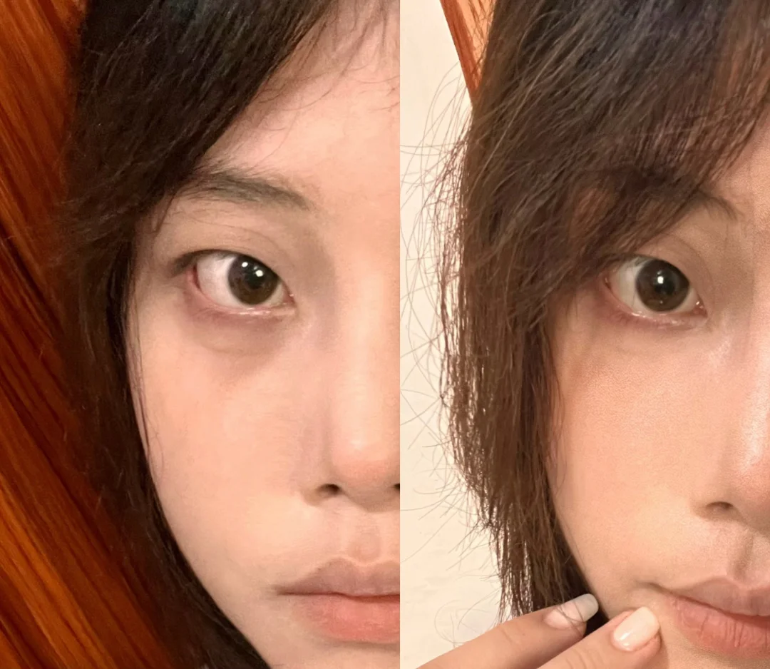 找吴叶用1＋1嘟的黑眼圈泪沟 有效果吗