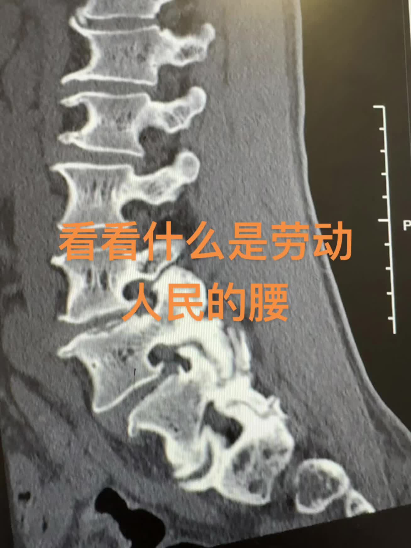劳动人民的腰 病人就是腰痛，休息后减轻。根据这几张CT片子，能给出几个...