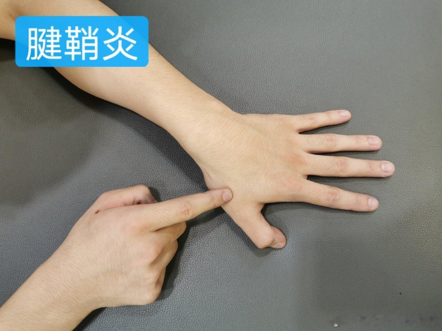 打工人常见的几种手腕疼痛 节前最后一天，来做个手腕损伤的自测和训练吧！如果一直疼