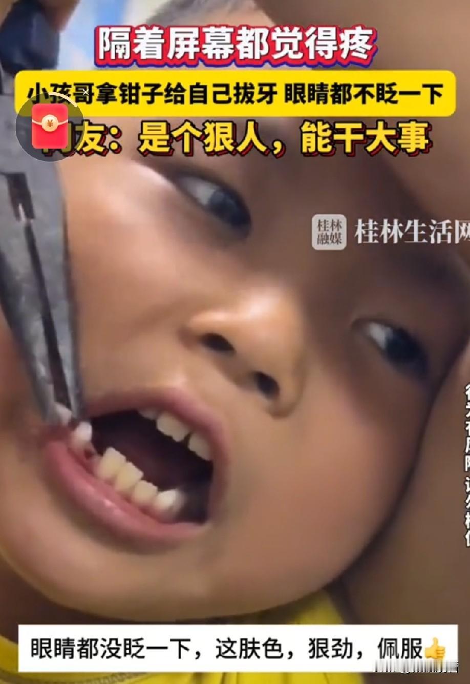 近日，陕西咸阳，9岁小男孩拿着老虎钳给自己拔松动乳牙，全程面无表情，连眉头都不皱