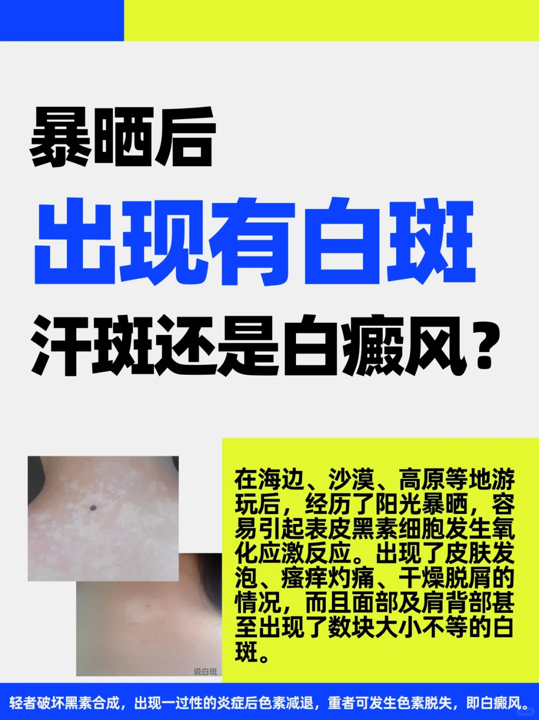 暴晒后出现白斑了，👒小心晒出白癜风