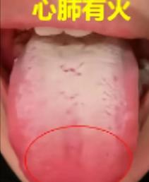 汗出不对=脏腑上火！脖子汗多心肺火、头汗多脾胃火、腿汗多肝肾火

1.脖子汗多、