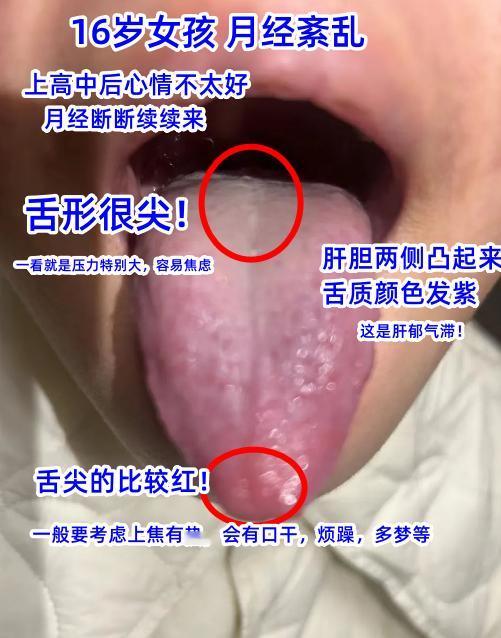 今日舌诊案例分析：肝郁气滞，湿热下注，痰阻三焦，外感风寒[谢谢][谢谢][谢谢]