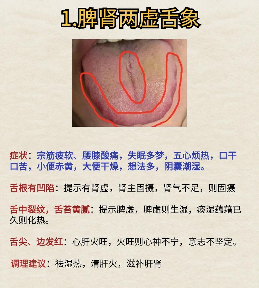 常见的几种舌象#中医健康##健康养生##舌象分析#