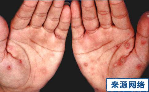 近日，一些中国留学生在日本分享了关于梅毒在当地扩散的情况，引起了广泛关注。根据他