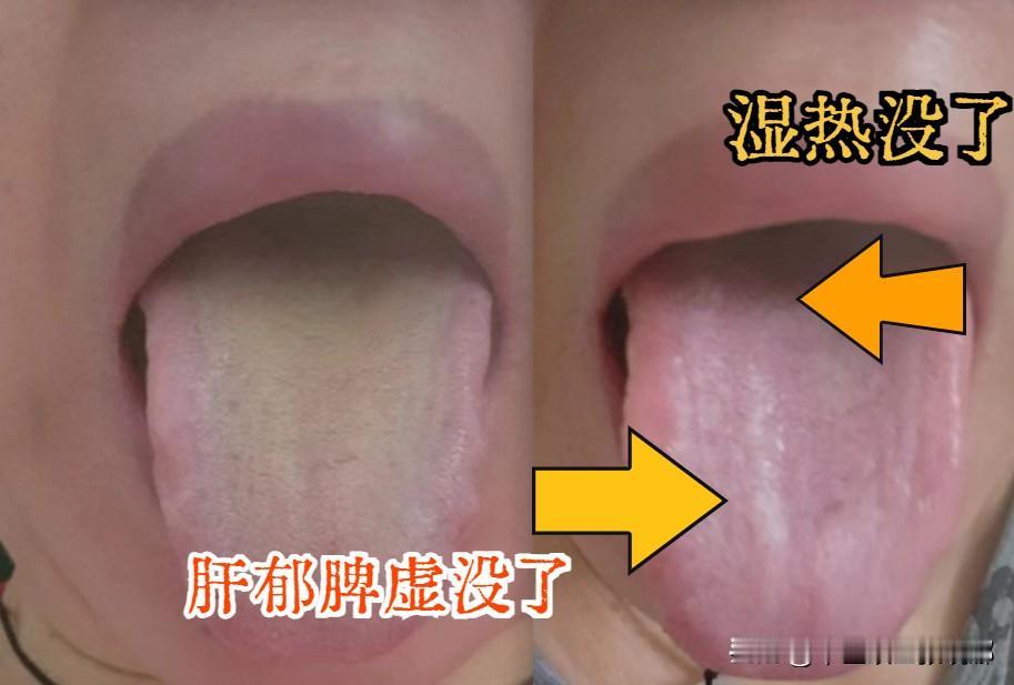 我只用3步，刮净了她的黄腻苔！

第一步：急则治其标：舌苔上黄腻厚重——清湿热，