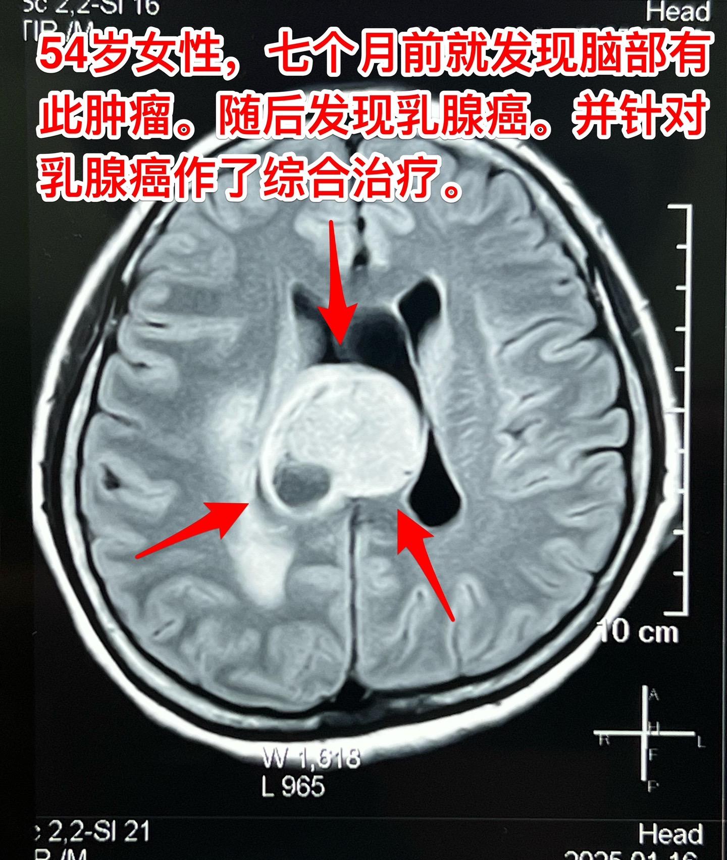 乳腺癌也能转移到脑部。脑部的转移瘤约80%来源于肺癌，绝大多数是腺癌。...