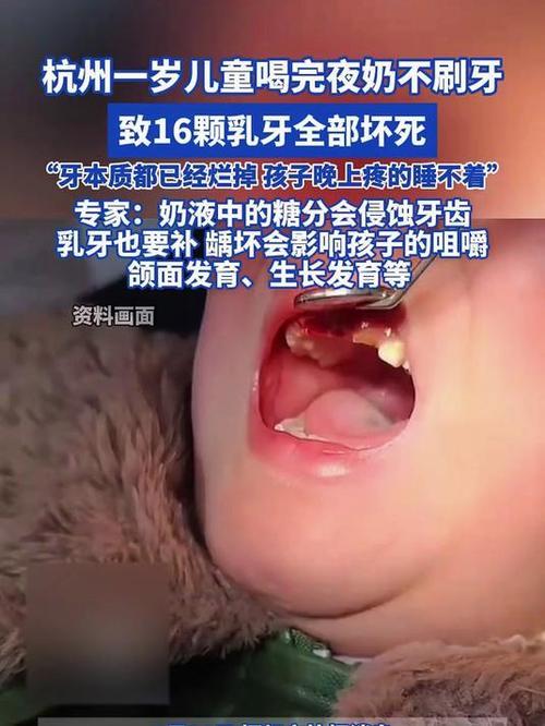 2025年9月，杭州1岁儿童因长期喝夜奶且未清洁口腔，导致16颗乳牙全部坏死，牙
