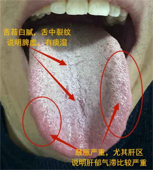 这种舌象，必须得把气理顺了，不然一点都补不进去，越补越要命！

一位患者来找我时