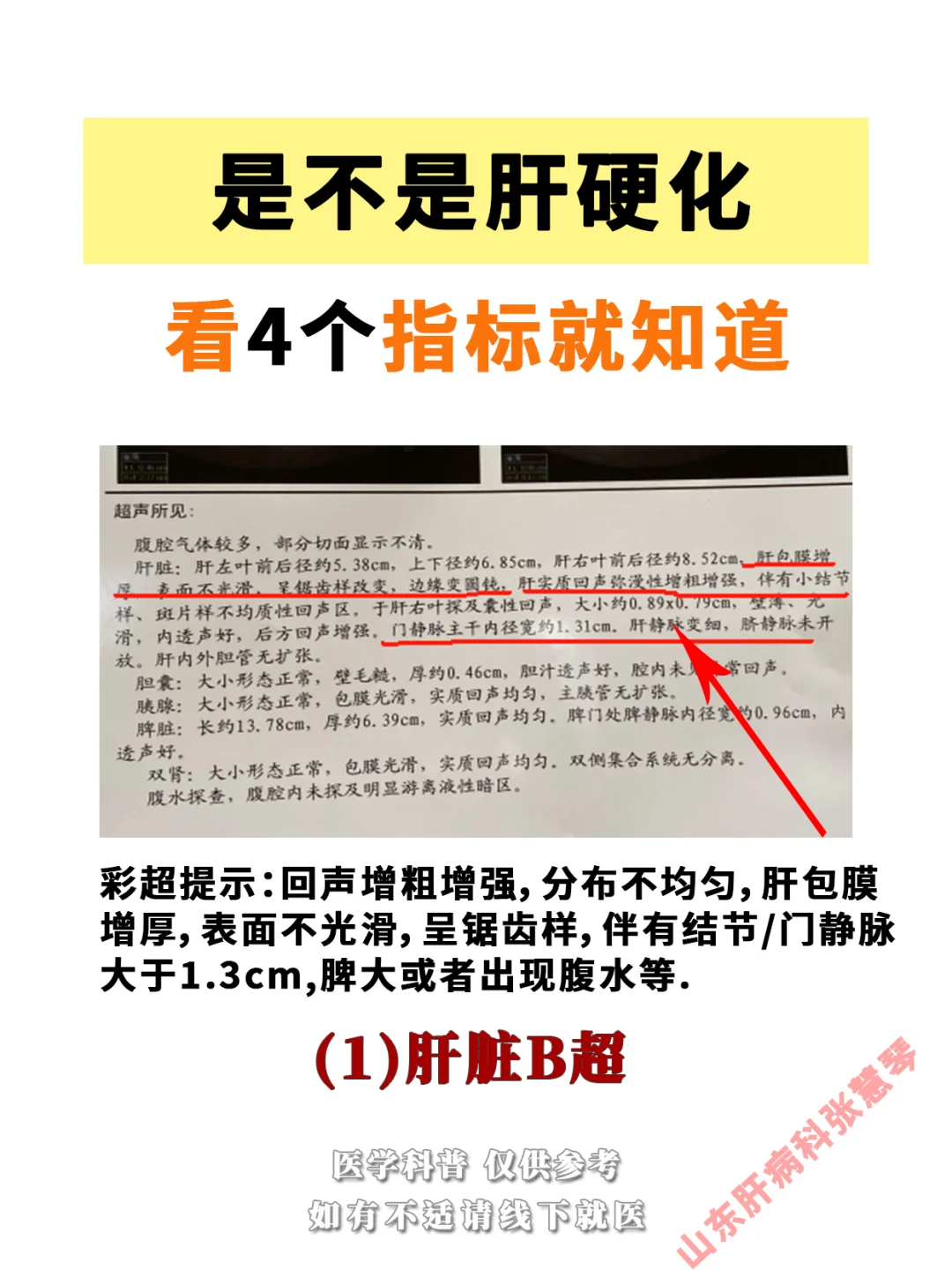 是不是肝硬化，看这4个指标就知道了！