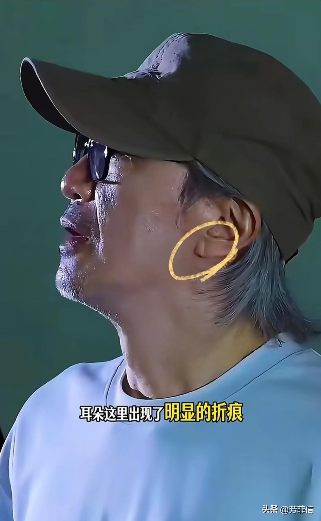 才注意到周星驰耳垂部位的深折痕，据悉这和全身动脉粥样硬化高度相关，所以这就是他多