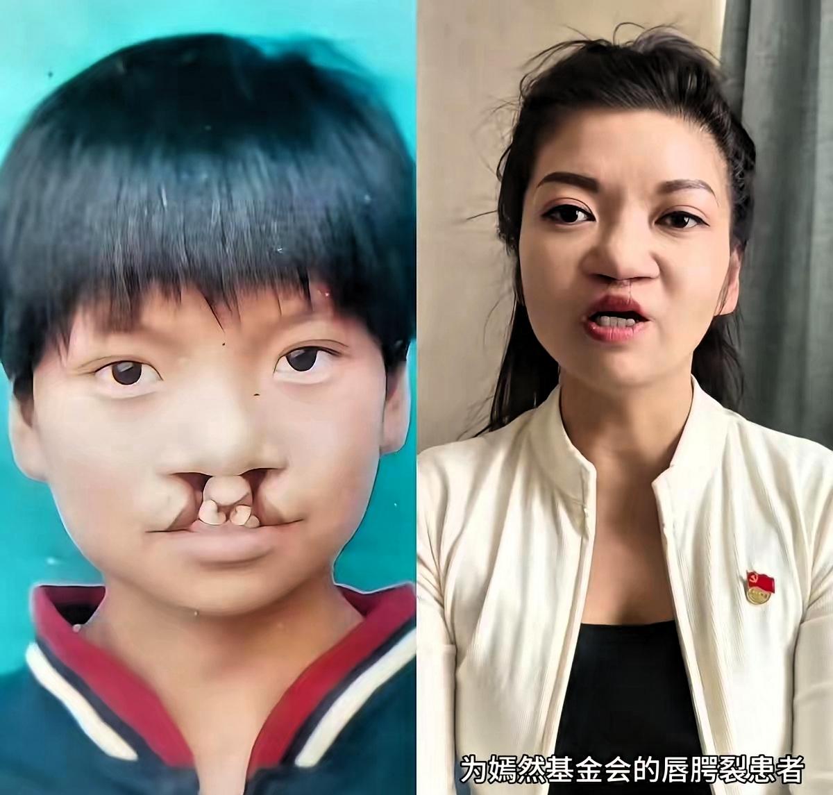 大家发现了没有
为什么那7000例免费治疗唇腭裂患大家发现了没有
为什么那700