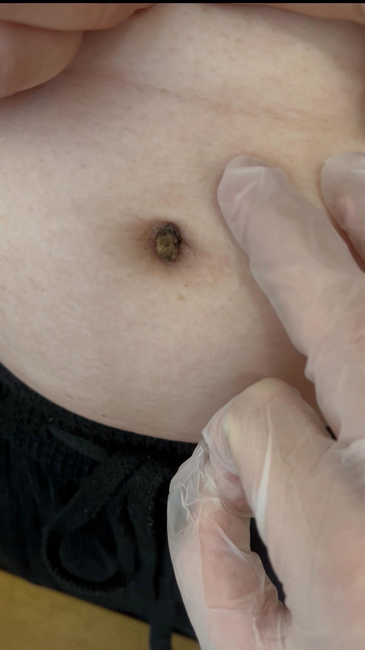 门诊来了一位姑娘，说是看了我的科普视频，让我帮她扣肚脐眼里的泥，已经二十几年了，