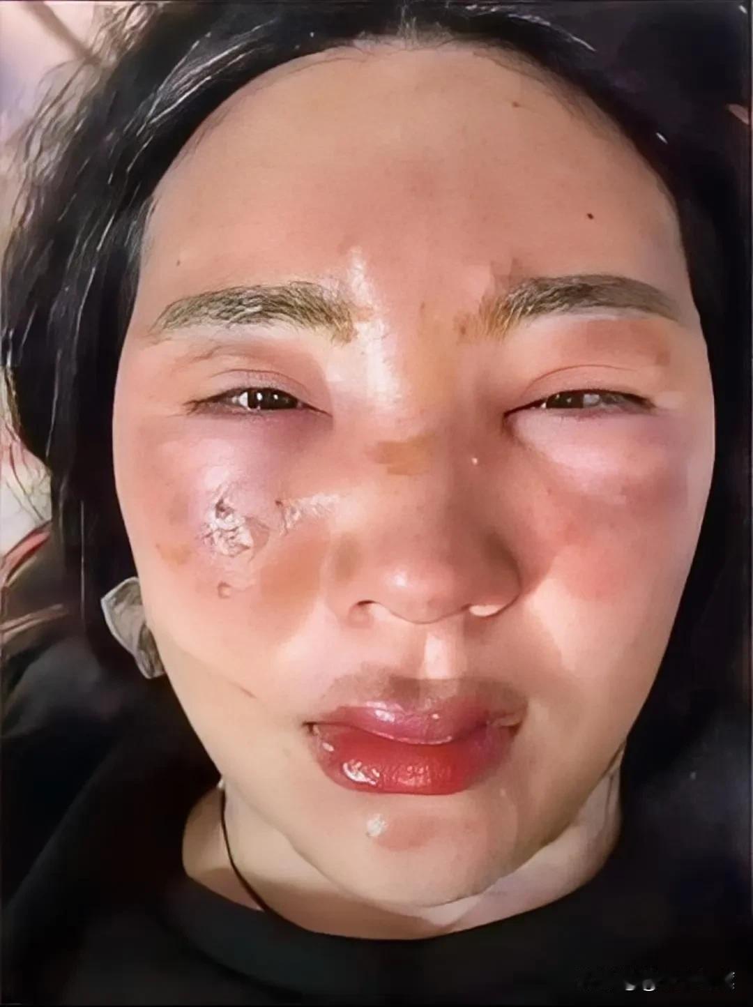 信宜自助餐烫伤事件：冲动是魔鬼冷静是良药！
昨晚，看到信宜自助餐烫伤事件的新闻，