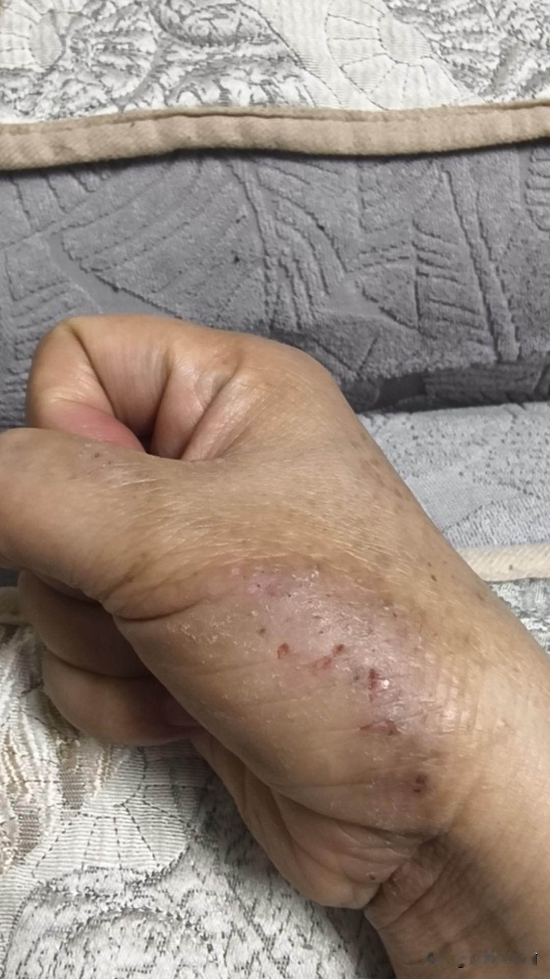 手上的湿疹反反复复折磨了我四五年，时好时坏，一直没法彻底根治。
 
这些年三甲医