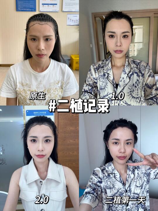 女生为了变美能有多拼？一年两次植发