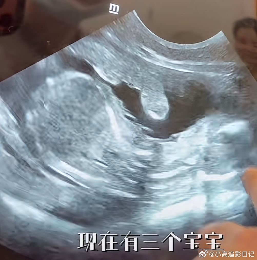 何浩畅怀孕了一下有两个好消息 畅姐有小宝宝啦 我们拾贰也是 nv好幸福好激动好惊