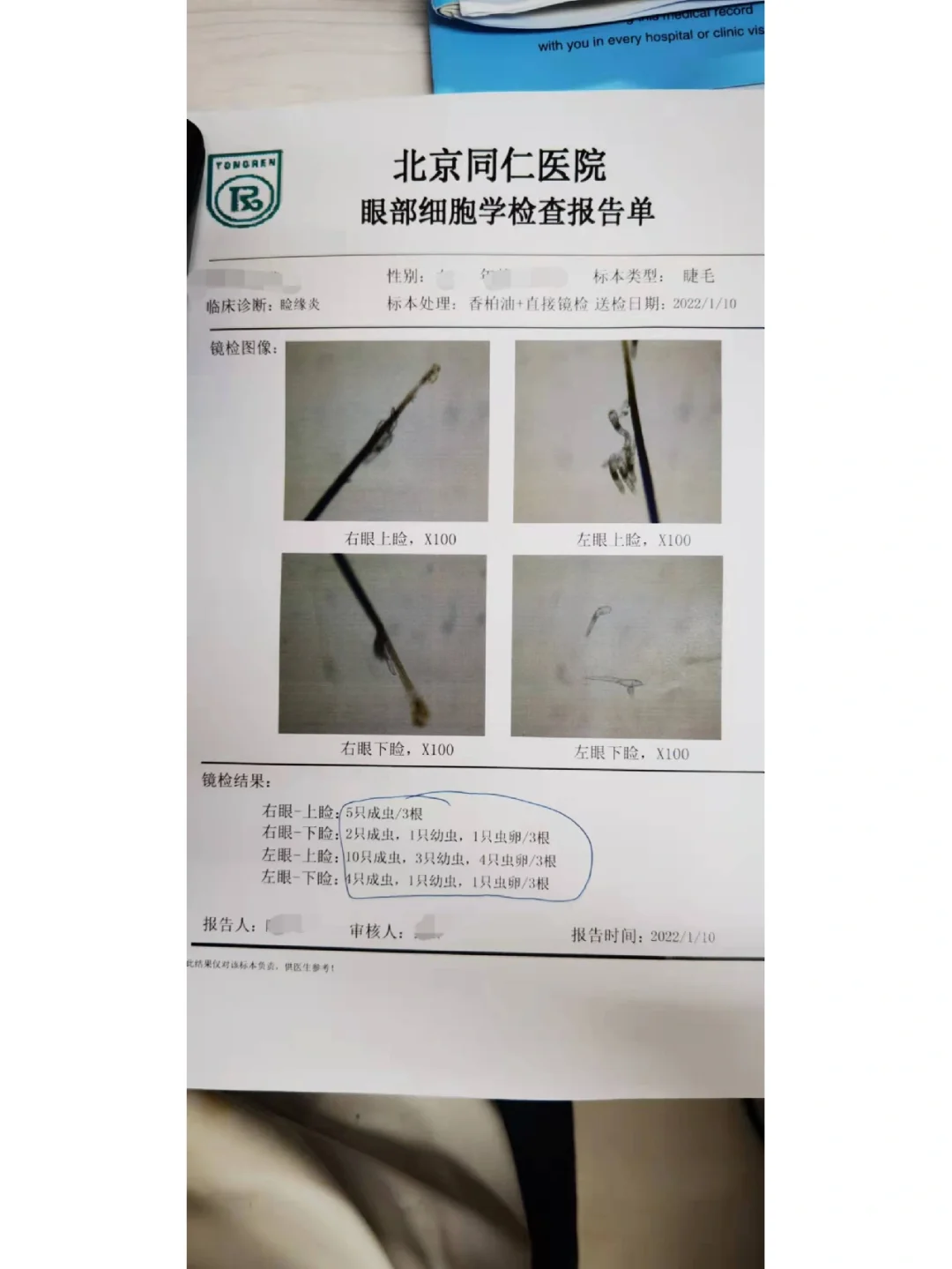 你睫毛掉的多？眼睛干痒？或许是有螨虫了