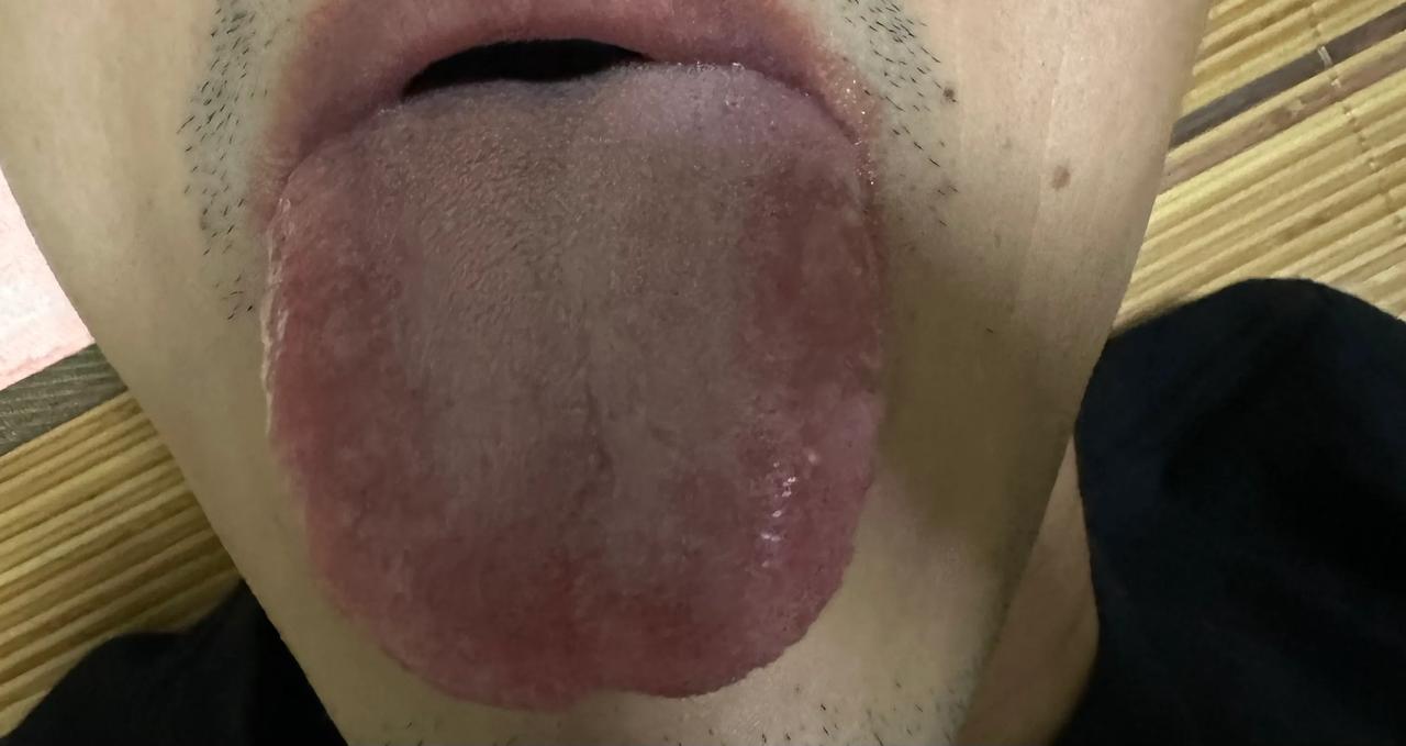 这舌头有什么问题吗？我自己的判断是肝郁脾虛，湿重，肺气不足。