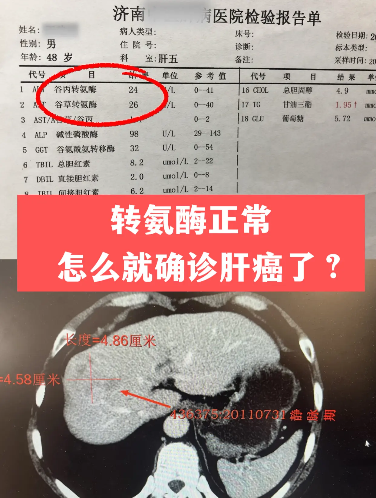 转氨酶正常，怎么就确诊肝癌了？。48岁的王先生在当地检查，确诊小肝癌...