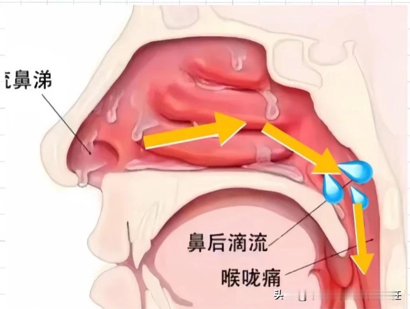 #鼻涕倒流主要症状有哪些?#简单总结主要有这9个典型症状，大家可以对照看看自己占