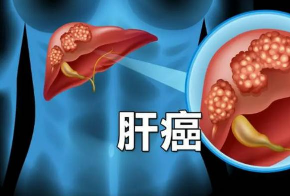 医生发现：早期肝癌不是腹痛，而是频繁出现这5个异常，需注意
很多人以为肝出问题，