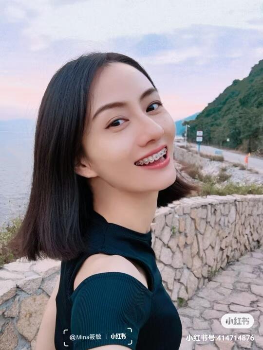 35岁戴牙套，到40岁时牙齿怎样了？