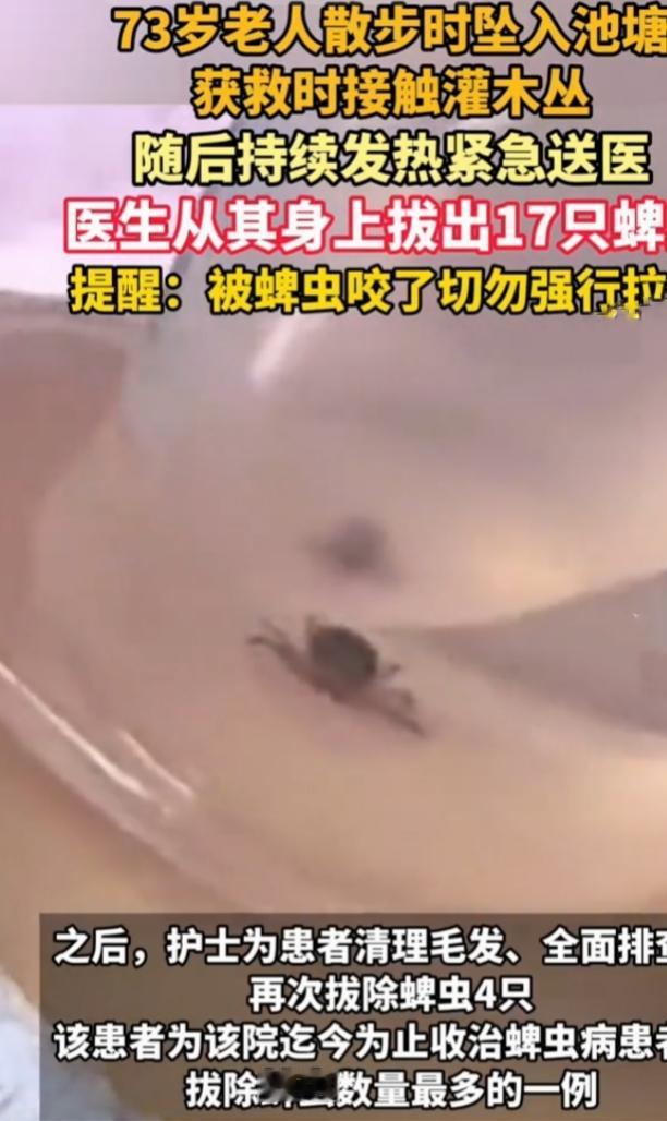 近日，安徽医科大学第四附属医院接诊了73岁的翟奶奶，医护人员竟从她身上拔除17只