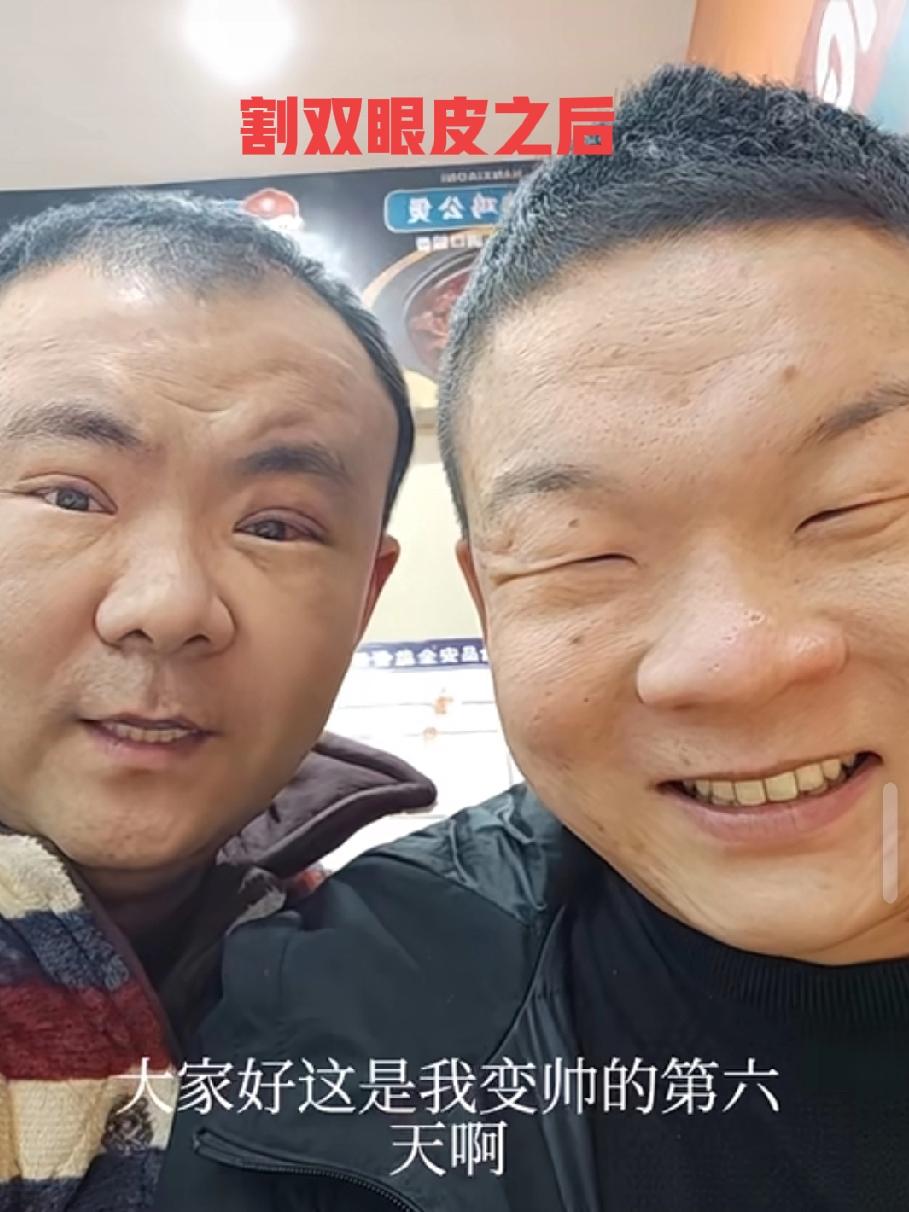 好一对难兄难弟，生下来俩人都是眯眯眼，经常被人打趣眼睛醒着和睡着一样睁不开。
