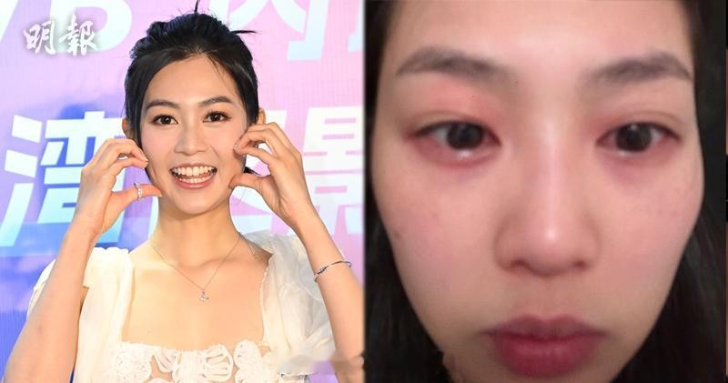 明报：郭柏妍俏脸消肿回复靓样 自爆“面目全非”相片吓坏妈咪郭柏妍日前在社交平台上