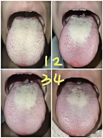 【舌诊分析】只用了三周时间，厚腻苔从大变小！

患者主诉：失眠多梦，睡眠质量非常