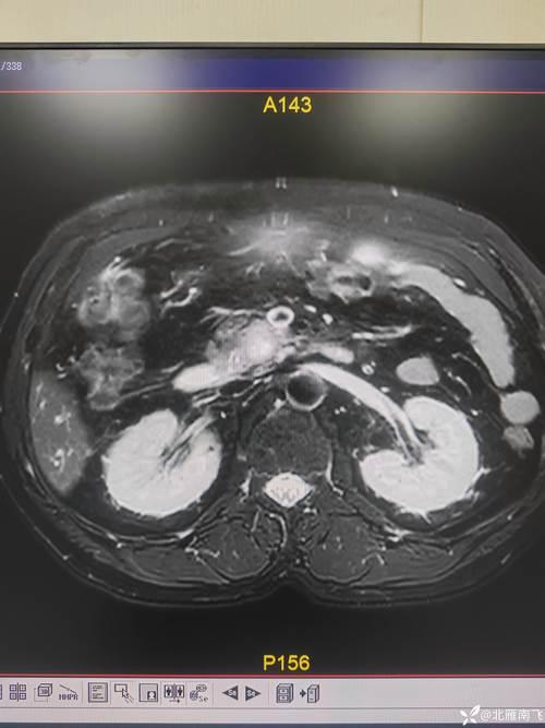 小伙腹痛CT查出肠道卡2把勺子
2026年3月1日，南京鼓楼医院接诊了一名神色痛