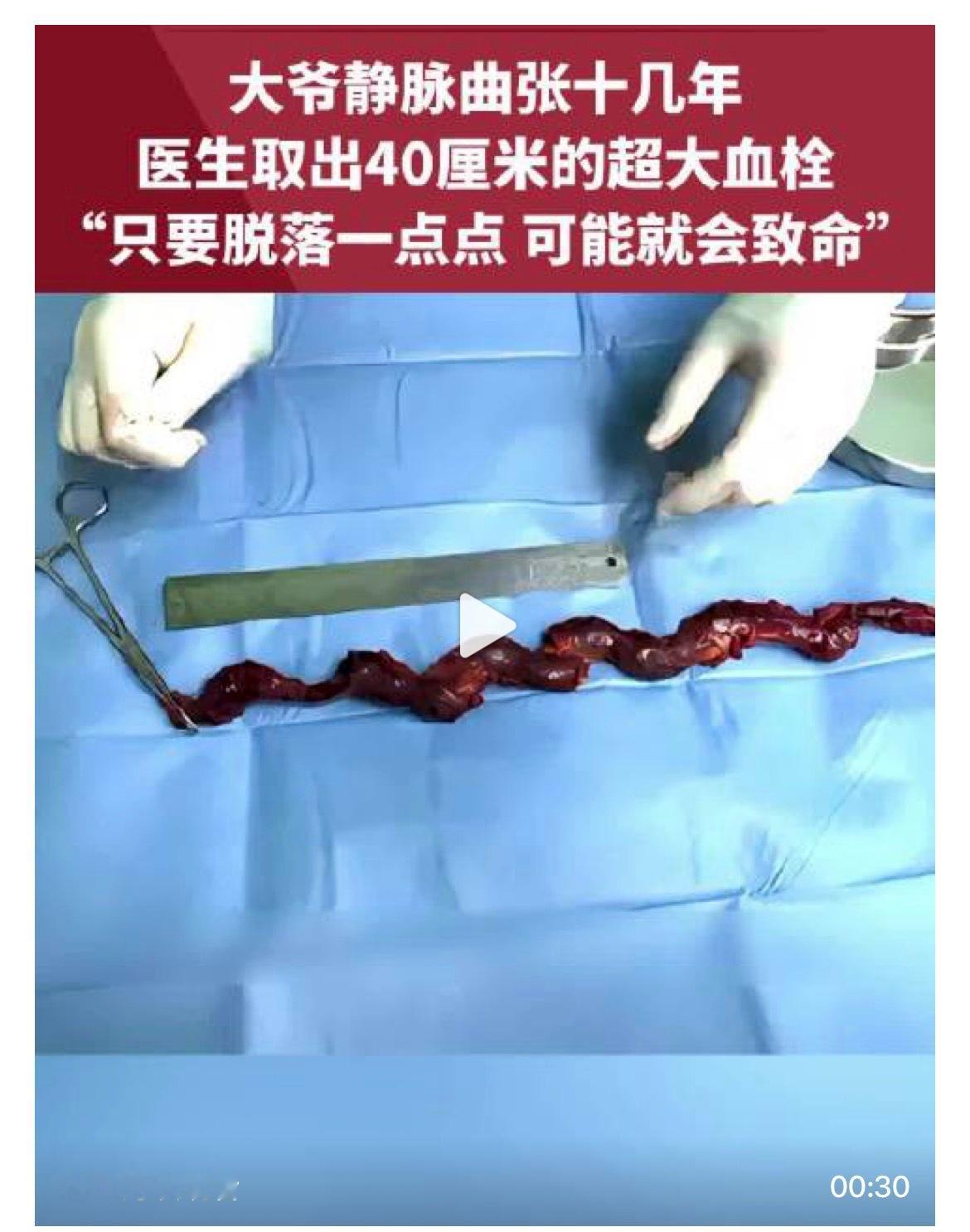北京大爷腿上取出40厘米血栓这事儿，真不是吓唬人。🩸很多人觉得静脉曲张就是腿上