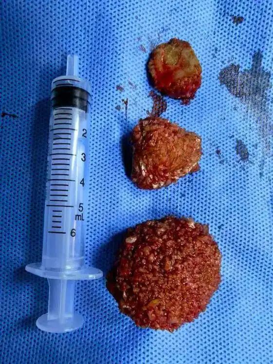 尿急尿频漏尿多年，7旬男子一天换三次内裤！医生：二十多年都很少碰到……这个习惯可