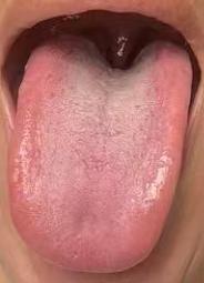 血糖容易偏高？中医视角来看，多和体内痰湿偏重有关





最近有不少人问我血糖