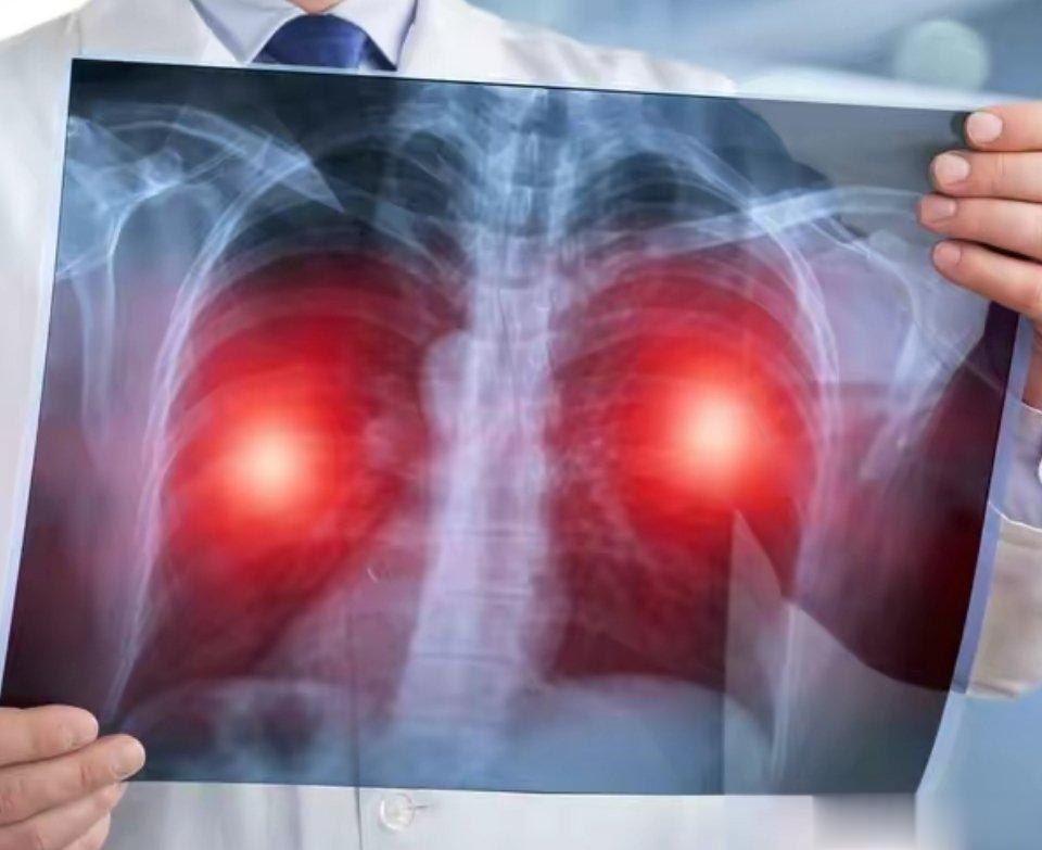 肺癌发生时，身体或有5个症状表现，早发现，早治疗肺癌是一种比较常见的疾病。近几年