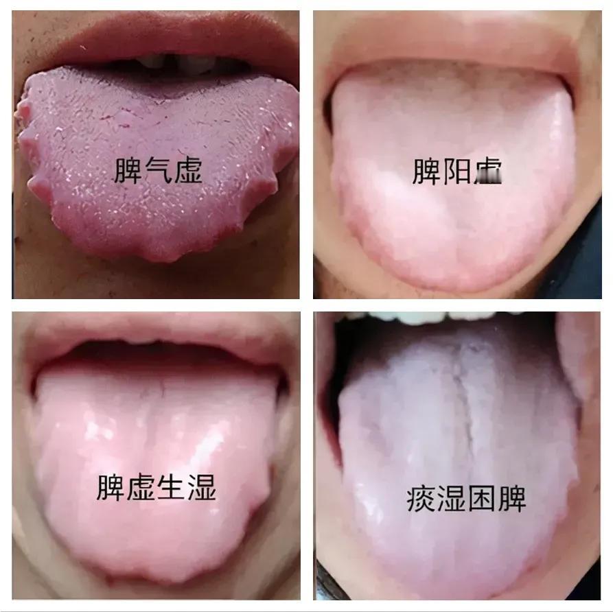 你是否经常感到身体乏力、大便不成形、失眠多梦？这可能与脾的四虚有关。今天，我们就